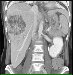 Unusual Liver Abscess - CTisus CT Scan