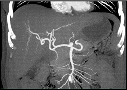 Normal Hepatic Artery - CTisus CT Scan