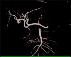 Normal Hepatic Artery - CTisus CT Scan