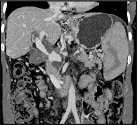 Partial Thrombosis of the Portal Vein - CTisus CT Scan