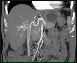 Cirrhosis and Cholangiocarcinoma - CTisus CT Scan