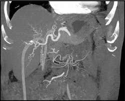 Biliary Stents and Cholangiocarcinoma - CTisus CT Scan