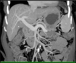 Hepatoma - CTisus CT Scan