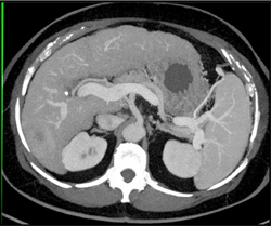 Hepatoma - CTisus CT Scan