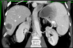 Hepatoma - CTisus CT Scan