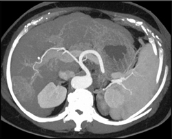 Hepatoma - CTisus CT Scan