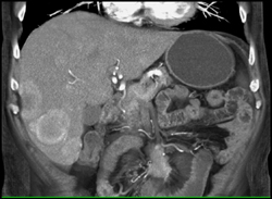 Metastatic Carcinoid Tumor - CTisus CT Scan