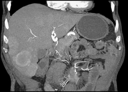 Metastatic Carcinoid Tumor - CTisus CT Scan