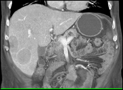 Metastatic Carcinoid Tumor - CTisus CT Scan