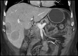 Metastatic Carcinoid Tumor - CTisus CT Scan