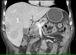 Metastatic Carcinoid Tumor - CTisus CT Scan