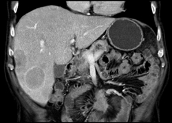 Metastatic Carcinoid Tumor - CTisus CT Scan