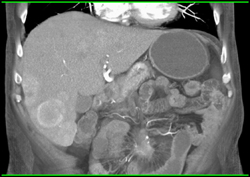 Metastatic Carcinoid Tumor - CTisus CT Scan