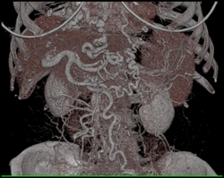 Varices in A Cirrhotic Patient - CTisus CT Scan