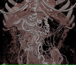 Varices in A Cirrhotic Liver - CTisus CT Scan