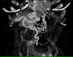 Cirrhosis - CTisus CT Scan