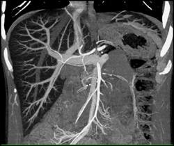 Fatty Liver - CTisus CT Scan