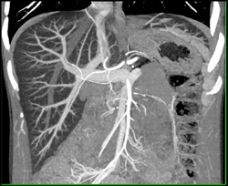 Fatty Liver - CTisus CT Scan