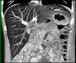 Fatty Liver - CTisus CT Scan