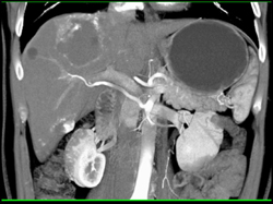 Hemangioma - CTisus CT Scan