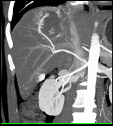 Hemangioma - CTisus CT Scan