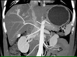 Hemangioma - CTisus CT Scan