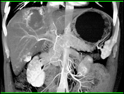 Hemangioma - CTisus CT Scan