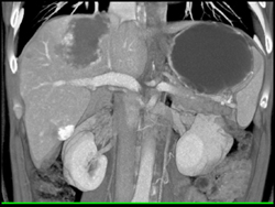 Hemangioma - CTisus CT Scan