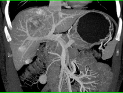 Hemangioma - CTisus CT Scan