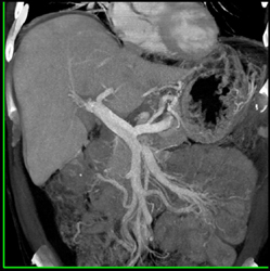 Transjugular Intrahepatic Portosystemic Shunt (TIPS) in Place - CTisus CT Scan