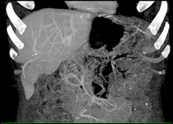 Hepatoma - CTisus CT Scan