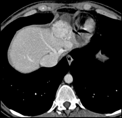 Hepatoma - CTisus CT Scan