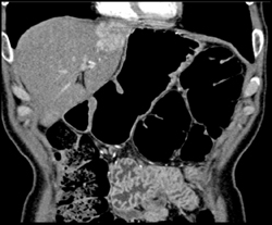 Hepatoma - CTisus CT Scan