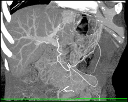 Hepatoma - CTisus CT Scan