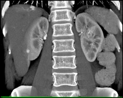 Hemangioma - CTisus CT Scan