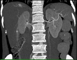 Hemangioma - CTisus CT Scan