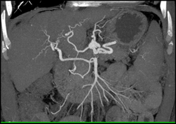 Abnormal Vessels - CTisus CT Scan