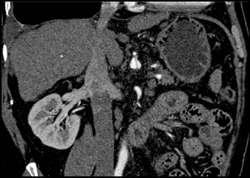 Cirrhosis - CTisus CT Scan