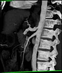 Focal Dissection in Celiac Artery - CTisus CT Scan