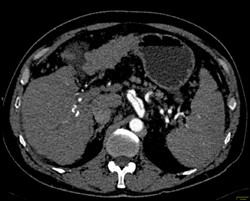 Cirrhosis With Dissection Into Celiac Artery - CTisus CT Scan