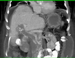 Portal Vein Thrombosis - CTisus CT Scan