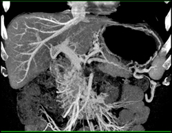 Duodenal Varices - CTisus CT Scan