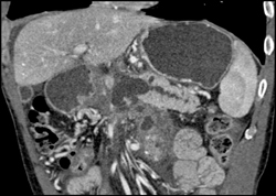 Intraductal Papillary Mucinous Neoplasm (IPMN) - CTisus CT Scan