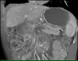 Intraductal Papillary Mucinous Neoplasm (IPMN) - CTisus CT Scan