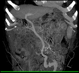 Dilated Unbilical Vein - CTisus CT Scan