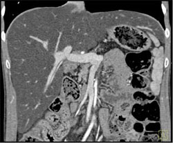 Fatty Liver - CTisus CT Scan