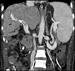 Partial Portal Vein Clot - CTisus CT Scan