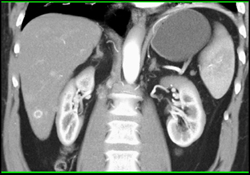 Hemangioma - CTisus CT Scan