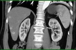 Metastatic Thyroid Cancer - CTisus CT Scan