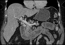 Cavernous Transformation of the Portal Vein - CTisus CT Scan